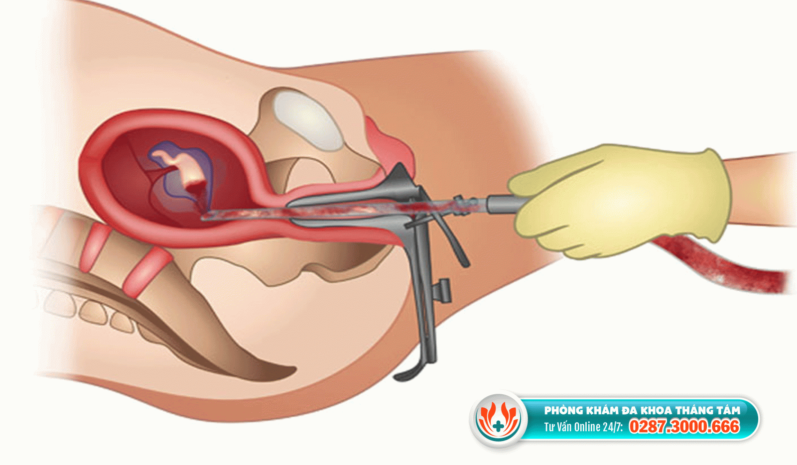 Hút thai chân không - Phương pháp phá thai 9 tuần